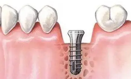 种植牙有什么风险和后遗症，种植牙的五大危害